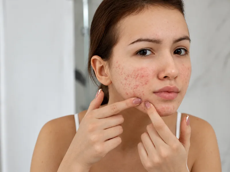 Ngừng dùng bột đậu đỏ nếu da xuất hiện dấu hiệu kích ứng